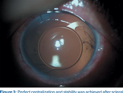 acriva ud 613 price in india|Scleral fixation of one piece intraocular lens by injector implantation.